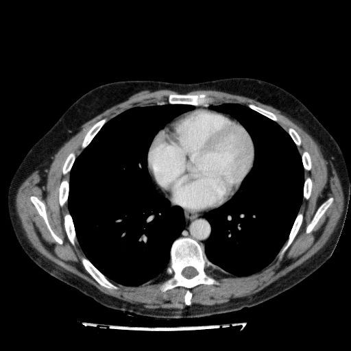 File:Acute cholecystitis and incidental left sided IVC (Radiopaedia 49352-54459 Axial C+ portal venous phase 14).jpg