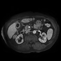 File:Acute cholecystitis complicated by pylephlebitis (Radiopaedia 65782-74915 Axial arterioportal phase T1 C+ fat sat 79).jpg