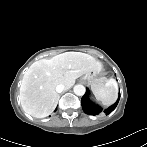 Acute cholecystitis with contained perforation (Radiopaedia 47328-51907 Axial C+ portal venous phase 15).png