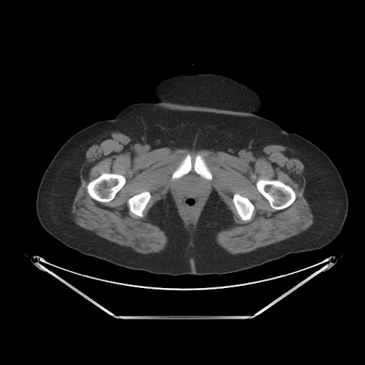 Acute cholecystitis with tensile fundus sign (Radiopaedia 71394-81723 Axial non-contrast 123).jpg
