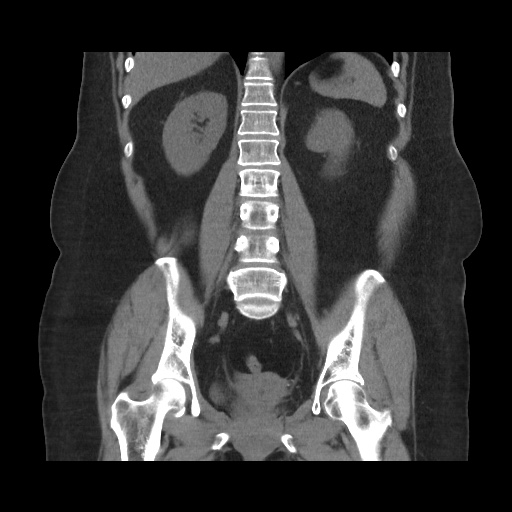 Acute cholecystitis with tensile fundus sign (Radiopaedia 71394-81723 Coronal non-contrast 82).jpg