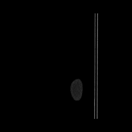 Acute cholecystitis with tensile fundus sign (Radiopaedia 71394-81723 Sagittal non-contrast 3).jpg