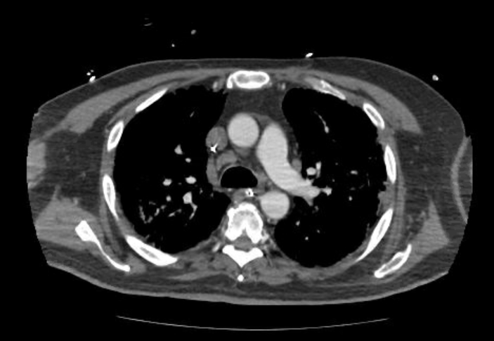File:Acute cor pulmonale (ultrasound) (Radiopaedia 83508-98818 Axial 126).jpg
