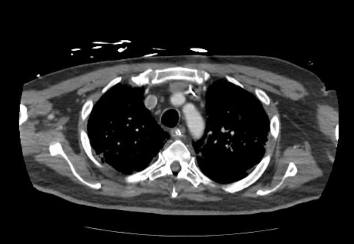 Acute cor pulmonale (ultrasound) (Radiopaedia 83508-98818 Axial C+ CTPA 15).jpg