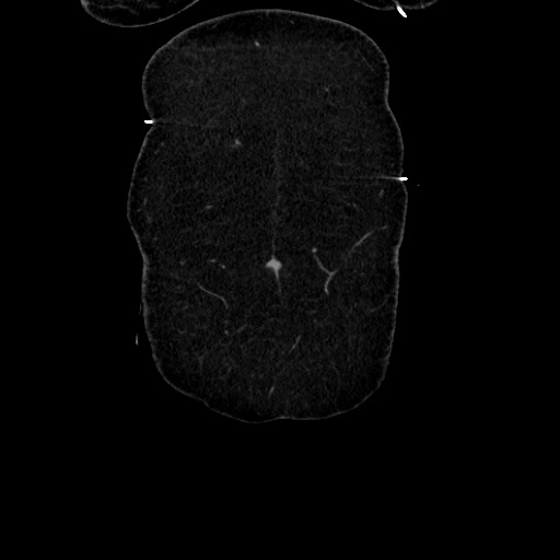 Acute diverticulitis - transverse colon (Radiopaedia 87063-103327 Coronal C+ portal venous phase 26).jpg
