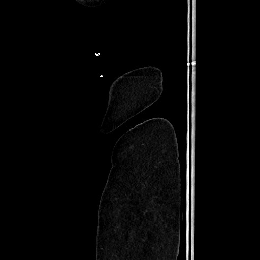Acute diverticulitis - transverse colon (Radiopaedia 87063-103327 Sagittal C+ portal venous phase 225).jpg