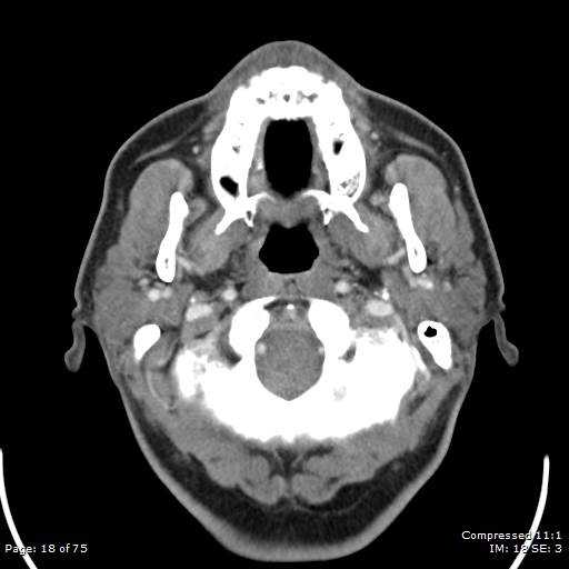 Acute epiglottitis (Radiopaedia 54375-60590 Axial C+ arterial phase 18).jpg