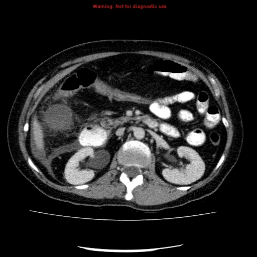 Acute gangrenous cholecystitis (Radiopaedia 10123-10661 Axial C+ portal venous phase 41).jpg