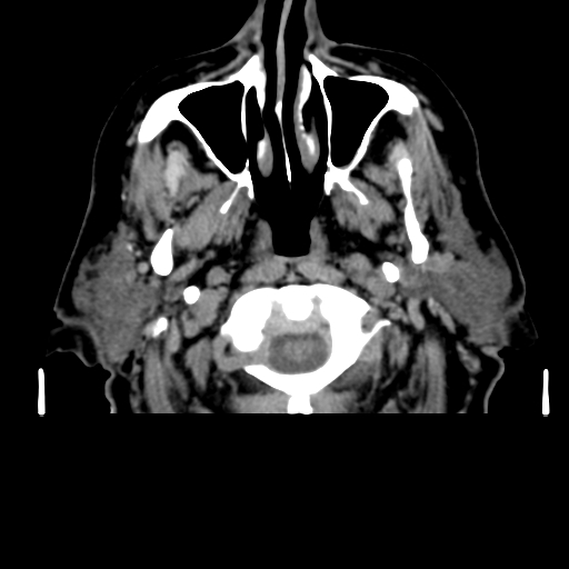 Acute hemorrhagic stroke (Radiopaedia 17507-17223 Axial non-contrast 3).jpg