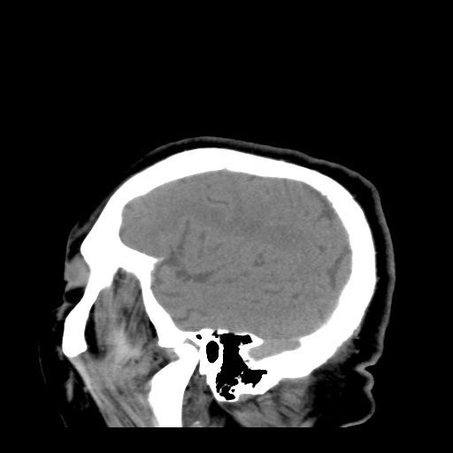 File:Acute hemorrhagic stroke (Radiopaedia 17507-17223 Sagittal non-contrast 38).jpg