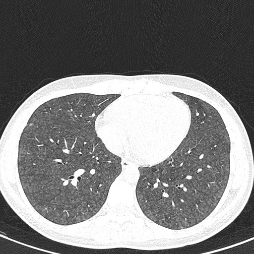 File:Acute hypersensitivity pneumonitis (Radiopaedia 85293-100870 Axial lung window 82).jpg