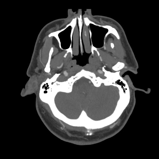 File:Acute internal carotid artery dissection (Radiopaedia 53541-59630 D 12).jpg