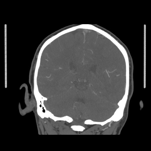 Acute internal carotid artery dissection (Radiopaedia 53541-59630 E 55).jpg