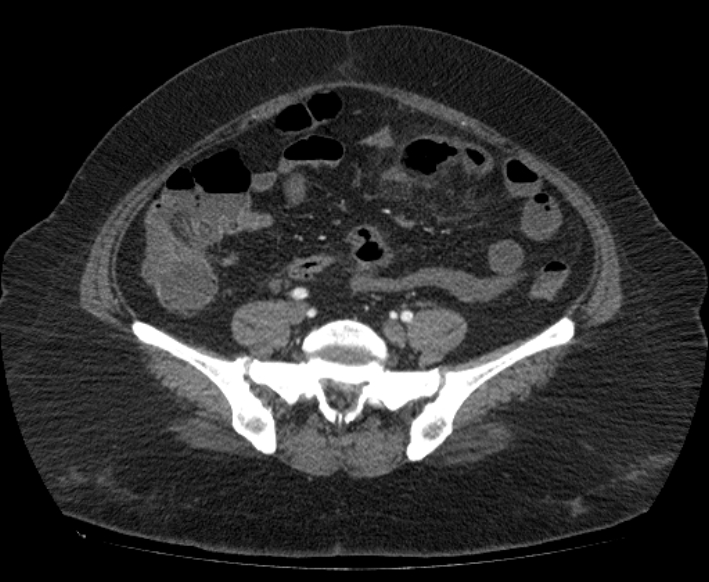 Acute mesenteric ischemia (Radiopaedia 80029-93316 Axial C+ arterial phase 91).jpg