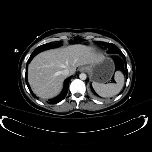 File:Acute myocardial infarction in CT (Radiopaedia 39947-42415 Axial C+ portal venous phase 21).jpg