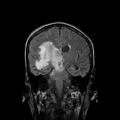 File:Acute necrotizing toxoplasma encephalitis (Radiopaedia 10683-11149 Coronal FLAIR 9).jpg