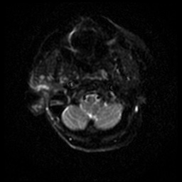 Acute otitis externa (Radiopaedia 57296-64236 Axial DWI 40).jpg