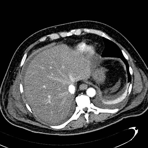 File:Acute pancreatic necrosis (Radiopaedia 13560-13486 Axial C+ portal venous phase 26).jpg
