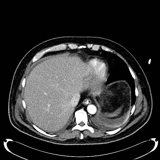 Acute pancreatic necrosis (Radiopaedia 13560-18500 Axial C+ portal venous phase 25).jpg