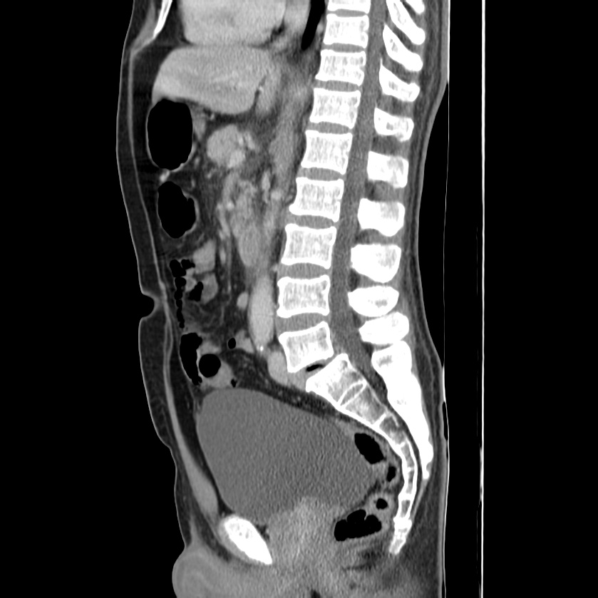 Acute pancreatitis (Radiopaedia 22572-22596 Sagittal C+ portal venous phase 28).jpg