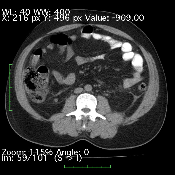 File:Acute pancreatitis (Radiopaedia 34043-35276 Axial non-contrast 59).jpg