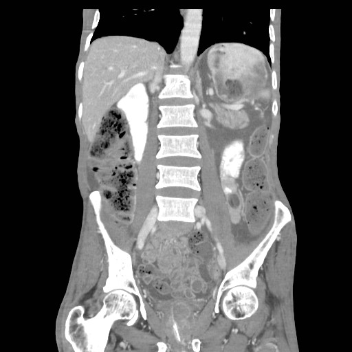 File:Acute pancreatitis (Radiopaedia 50213-55558 Coronal C+ portal venous phase 25).jpg