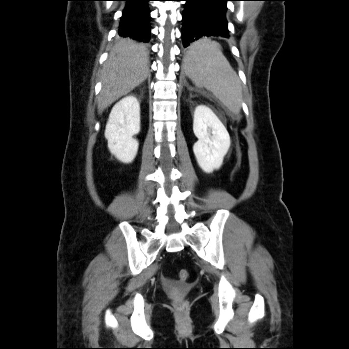 Acute pancreatitis (Radiopaedia 69236-79012 Coronal C+ portal venous phase 27).jpg