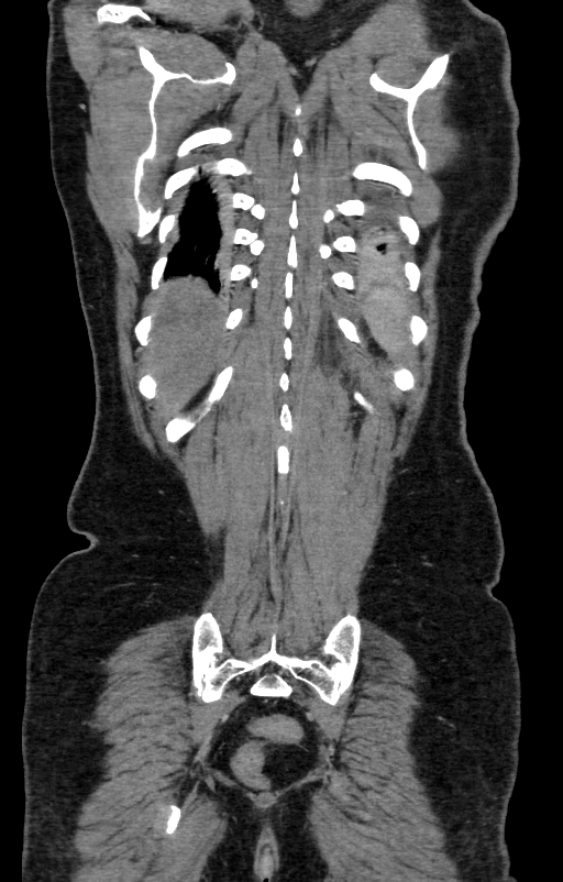 Acute pancreatitis (Radiopaedia 80007-93285 Coronal C+ portal venous phase 132).jpg