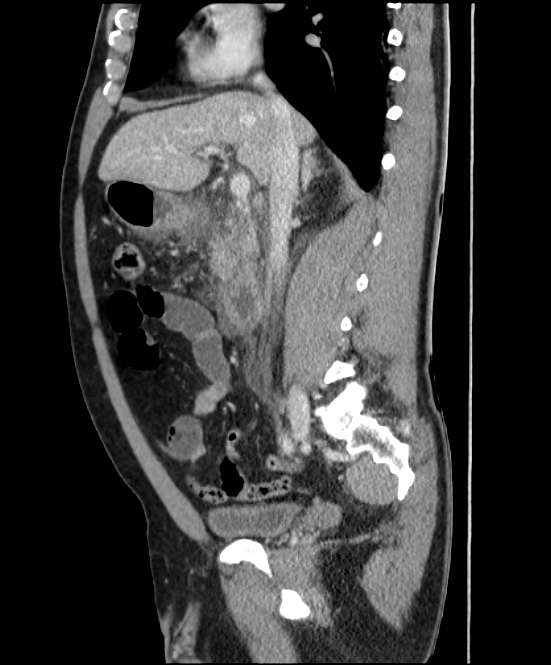 Acute pancreatitis - Balthazar E (Radiopaedia 23080-23110 Sagittal C+ portal venous phase 39).jpg