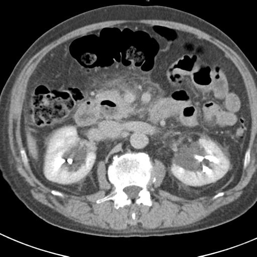 File:Acute pancreatitis and walled-off necrosis (Radiopaedia 29888-30403 Axial C+ delayed 35).jpg