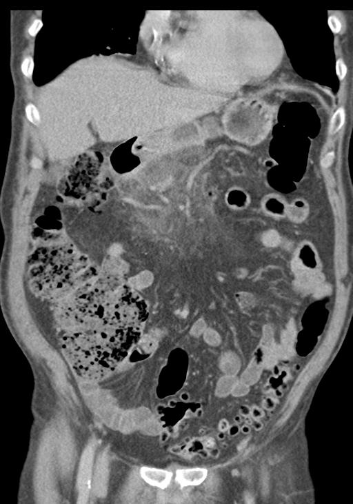 Acute pancreatitis and walled-off necrosis (Radiopaedia 29888-30403 E 20).jpg