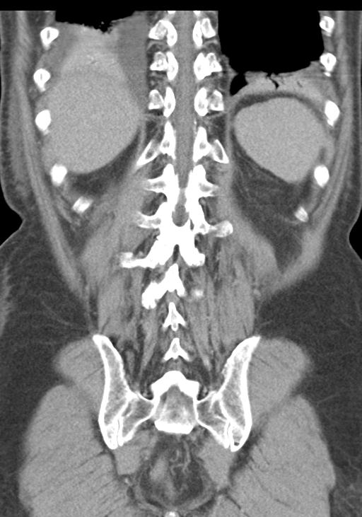 Acute pancreatitis and walled-off necrosis (Radiopaedia 29888-30403 E 46).jpg