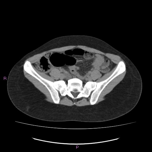 Acute pancreatitis secondary to stone at minor papilla and pancreatic divisum (Radiopaedia 76570-88333 Axial non-contrast 55).jpg