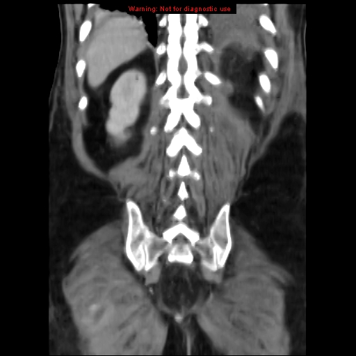 Acute pancreatitis with incidental pancreatic lipoma (Radiopaedia 10190-10730 Coronal C+ portal venous phase 61).jpg