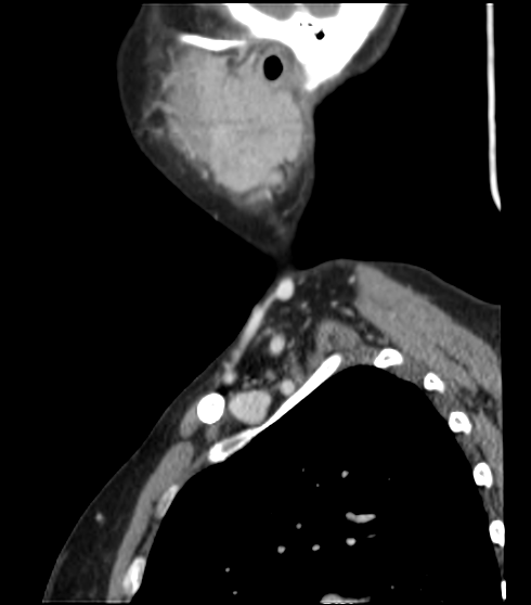 File:Acute parotitis (Radiopaedia 27425-27619 Sagittal C+ portal venous phase 9).png
