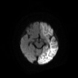 File:Acute phase of hemiconvulsion-hemiplegia epilepsy syndrome (Radiopaedia 29309-29745 Axial DWI 11).jpg