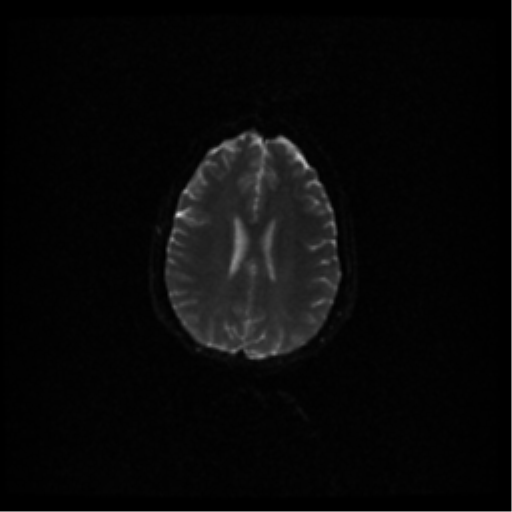 File:Acute pontine infarct from vertebral artery dissection (Radiopaedia 34111-35370 Axial DWI 39).png