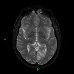 Acute posterior cerebral artery territory infarct (Radiopaedia 79329-92394 Axial DWI 42).jpg