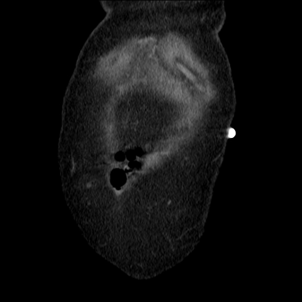 Acute pyelonephritis (Radiopaedia 26584-26729 C+ portal venous phase 8).jpg