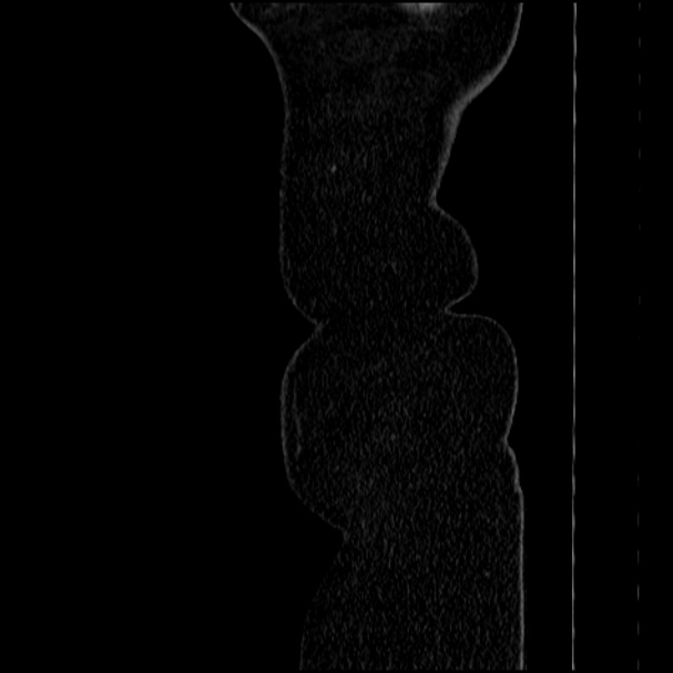 Acute pyelonephritis (Radiopaedia 33397-34434 Sagittal renal parenchymal phase 2).jpg