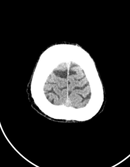 Acute superior cerebellar artery territory infarct (Radiopaedia 84104-99359 Axial non-contrast 12).jpg