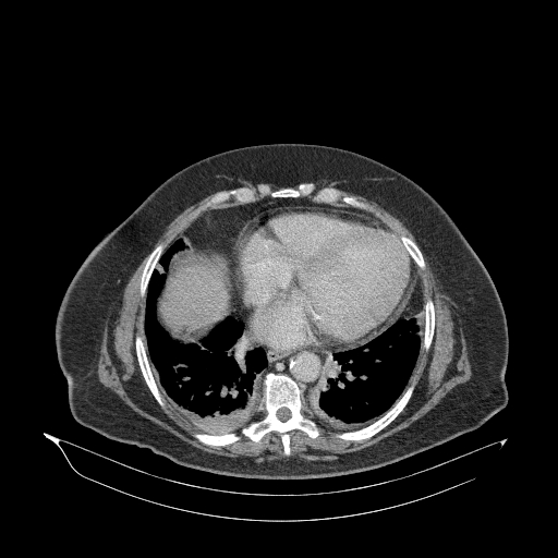 File:Acute superior mesenteric artery occlusion (Radiopaedia 51288-56960 Axial C+ portal venous phase 4).jpg