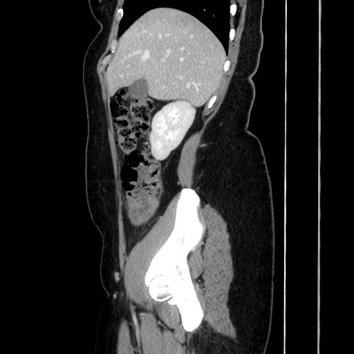 Acute uncomplicated appendicitis (Radiopaedia 73704-84499 Sagittal C+ portal venous phase 74).jpg