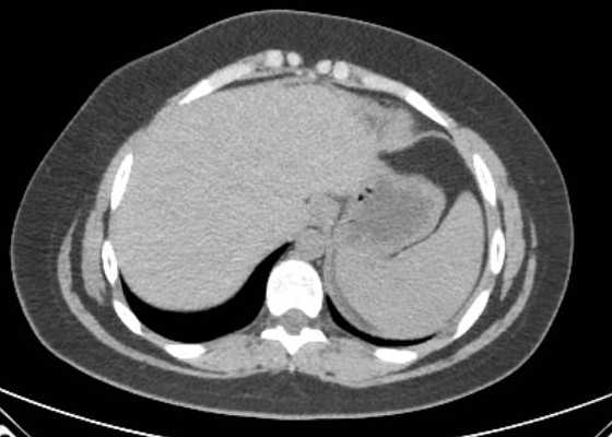 Acute unilateral nonhemorrhagic adrenal infarction (Radiopaedia 67560-76957 Axial non-contrast 1).jpg