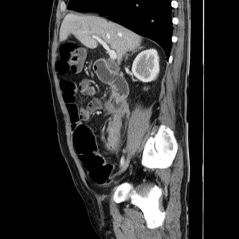 Adenocarcinoma of colon with entero-colic fistula (Radiopaedia 22832-22852 Sagittal C+ portal venous phase 24).jpg