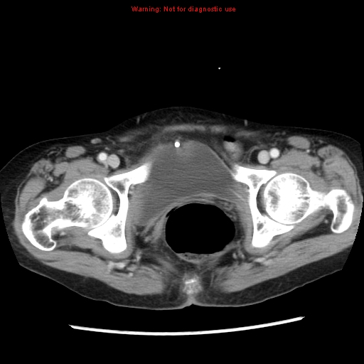 File:Adenocarcinoma of the colon (Radiopaedia 8191-9039 Axial liver window 72).jpg