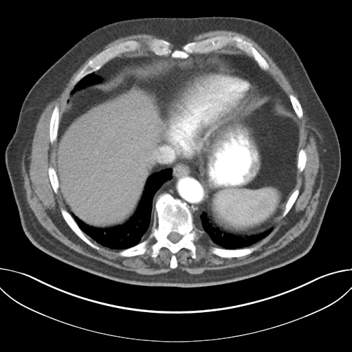 File:Adenocarcioma of rectum- T1 lesion (Radiopaedia 36921-38547 Axial C+ arterial phase 44).png