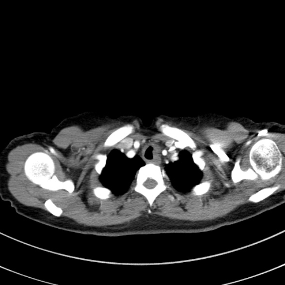 File:Adenocystic carcinoma of the trachea (Radiopaedia 47677-52525 Axial C+ arterial phase 31).jpg
