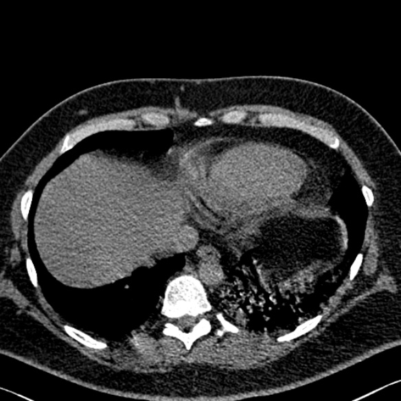 Adenoid cystic carcinoma of the trachea (Radiopaedia 49042-54137 Axial non-contrast 274).jpg