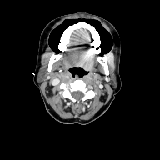 File:Adenoid cystic tumor of palate (Radiopaedia 46980-51518 Axial C+ delayed 33).png